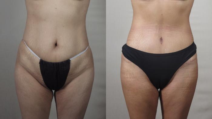 Brazilian Butt Lift Case 1497 Before & After Front | Paramus, New Jersey | Parker Center for Plastic Surgery