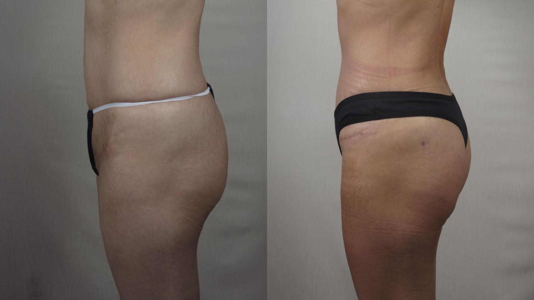 Brazilian Butt Lift Case 1497 Before & After Left Side | Paramus, New Jersey | Parker Center for Plastic Surgery