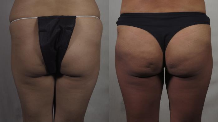 Brazilian Butt Lift Case 1500 Before & After Back | Paramus, New Jersey | Parker Center for Plastic Surgery