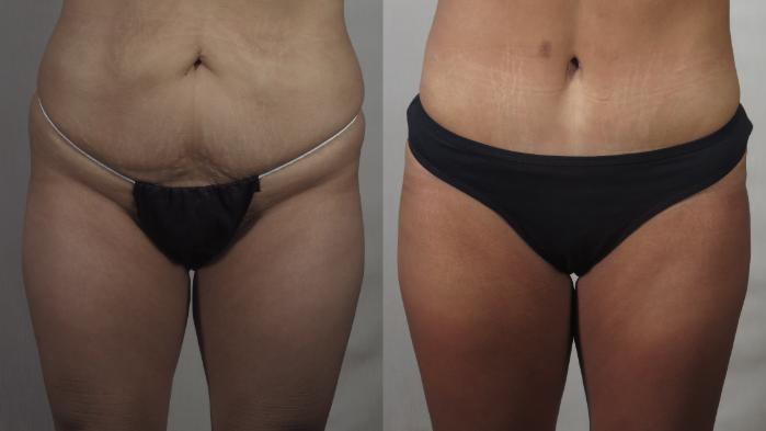 Brazilian Butt Lift Case 1500 Before & After Front | Paramus, New Jersey | Parker Center for Plastic Surgery