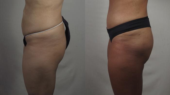 Brazilian Butt Lift Case 1500 Before & After Left Side | Paramus, New Jersey | Parker Center for Plastic Surgery