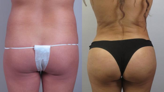 Brazilian Butt Lift Case 1603 Before & After Back | Paramus, New Jersey | Parker Center for Plastic Surgery