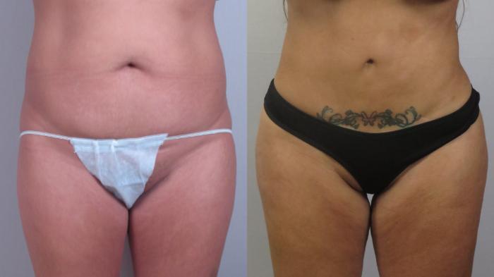 Brazilian Butt Lift Case 1603 Before & After Front | Paramus, New Jersey | Parker Center for Plastic Surgery