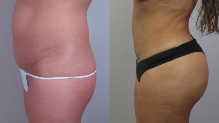Brazilian Butt Lift Case 1603 Before & After Left Side | Paramus, New Jersey | Parker Center for Plastic Surgery