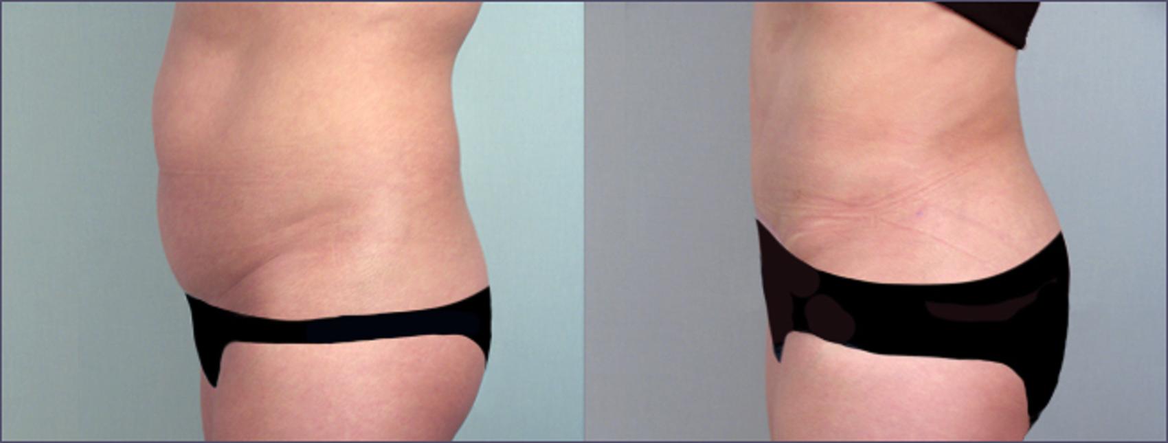 Brazilian Butt Lift Case 691 Before & After View #2 | Paramus, NJ | Parker Center for Plastic Surgery