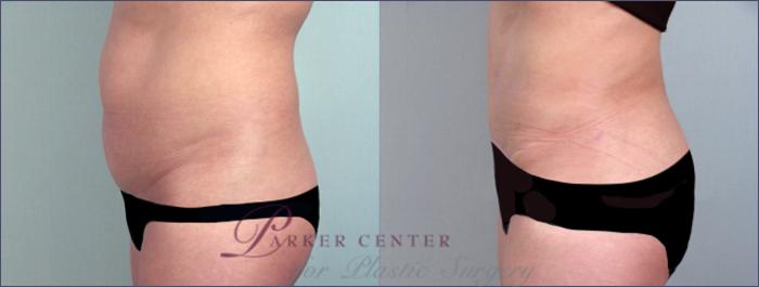 Brazilian Butt Lift Case 691 Before & After View #2 | Paramus, NJ | Parker Center for Plastic Surgery