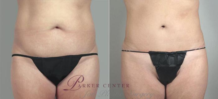 Brazilian Butt Lift Case 717 Before & After View #1 | Paramus, NJ | Parker Center for Plastic Surgery