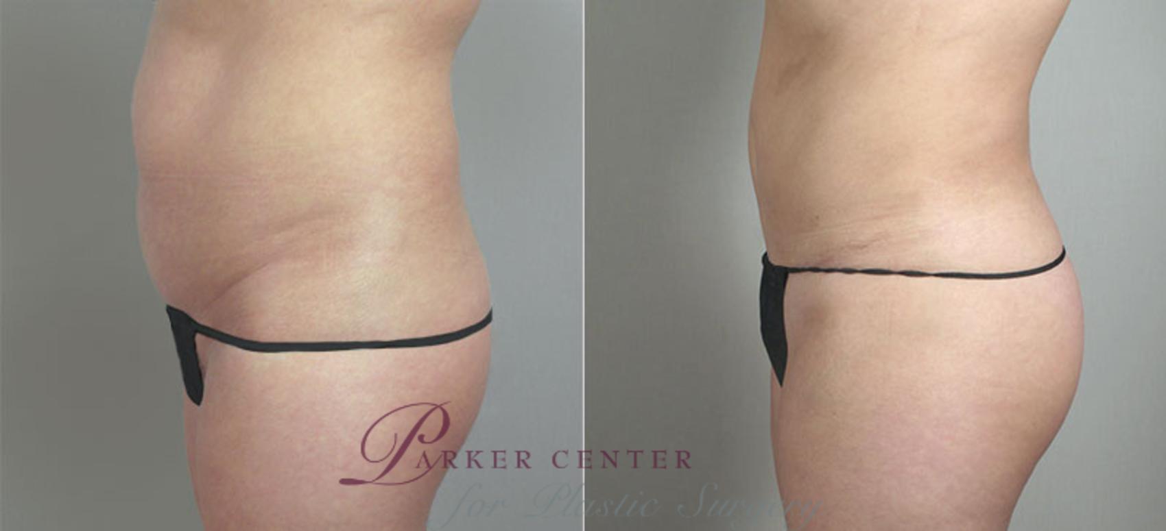 Brazilian Butt Lift Case 717 Before & After View #2 | Paramus, NJ | Parker Center for Plastic Surgery