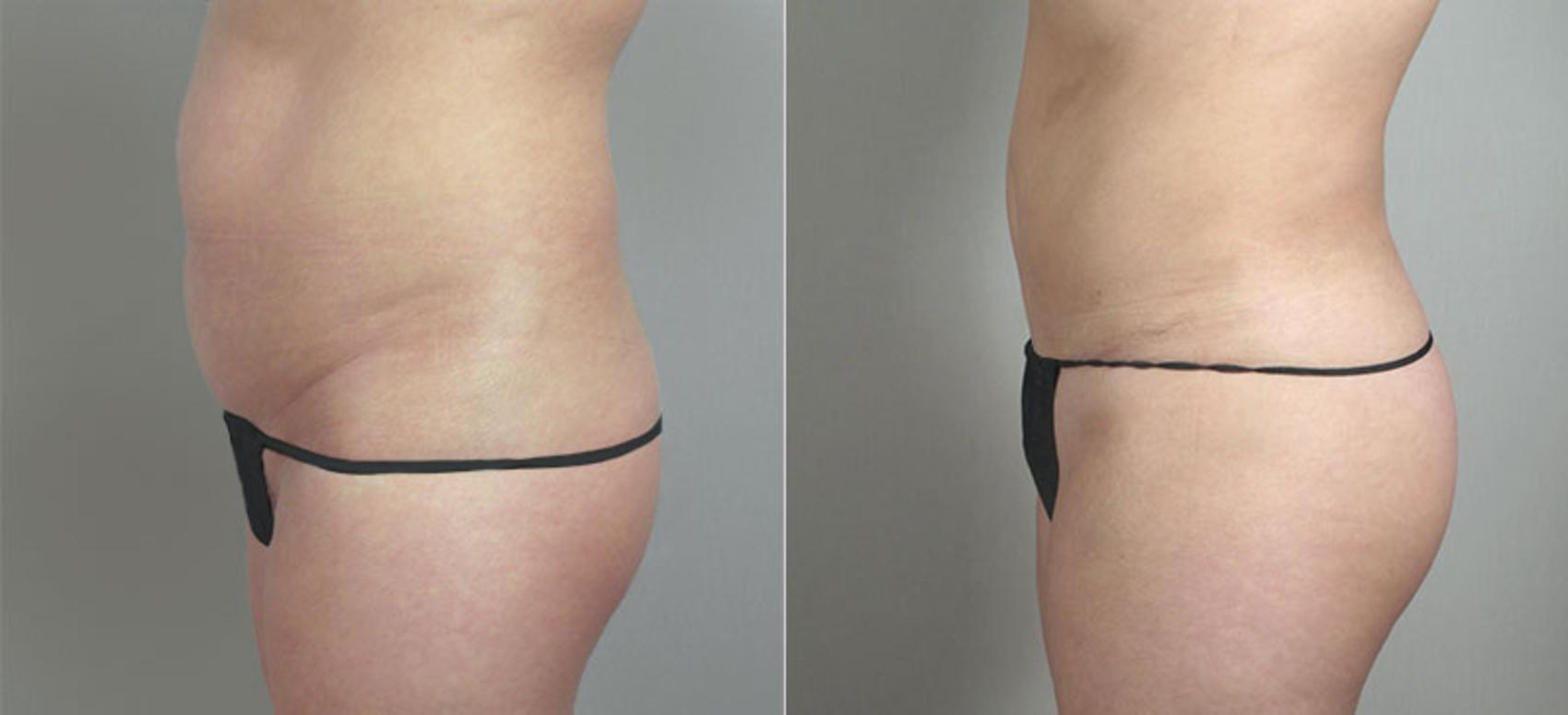 Brazilian Butt Lift Case 717 Before & After View #2 | Paramus, New Jersey | Parker Center for Plastic Surgery