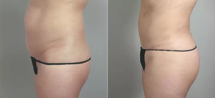 Patient #10365 Brazilian Butt Lift Before and After Photos Beverly