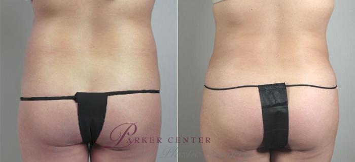 Brazilian Butt Lift Case 717 Before & After View #3 | Paramus, NJ | Parker Center for Plastic Surgery