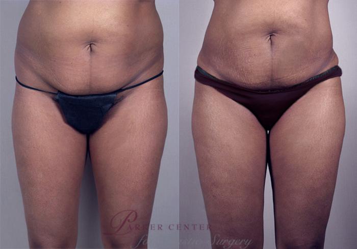 Brazilian Butt Lift Case 775 Before & After View #1 | Paramus, NJ | Parker Center for Plastic Surgery