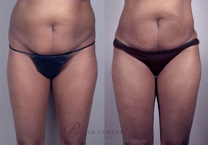 Before and After Brazilian Butt Lift Case 7, Westfield, NJ