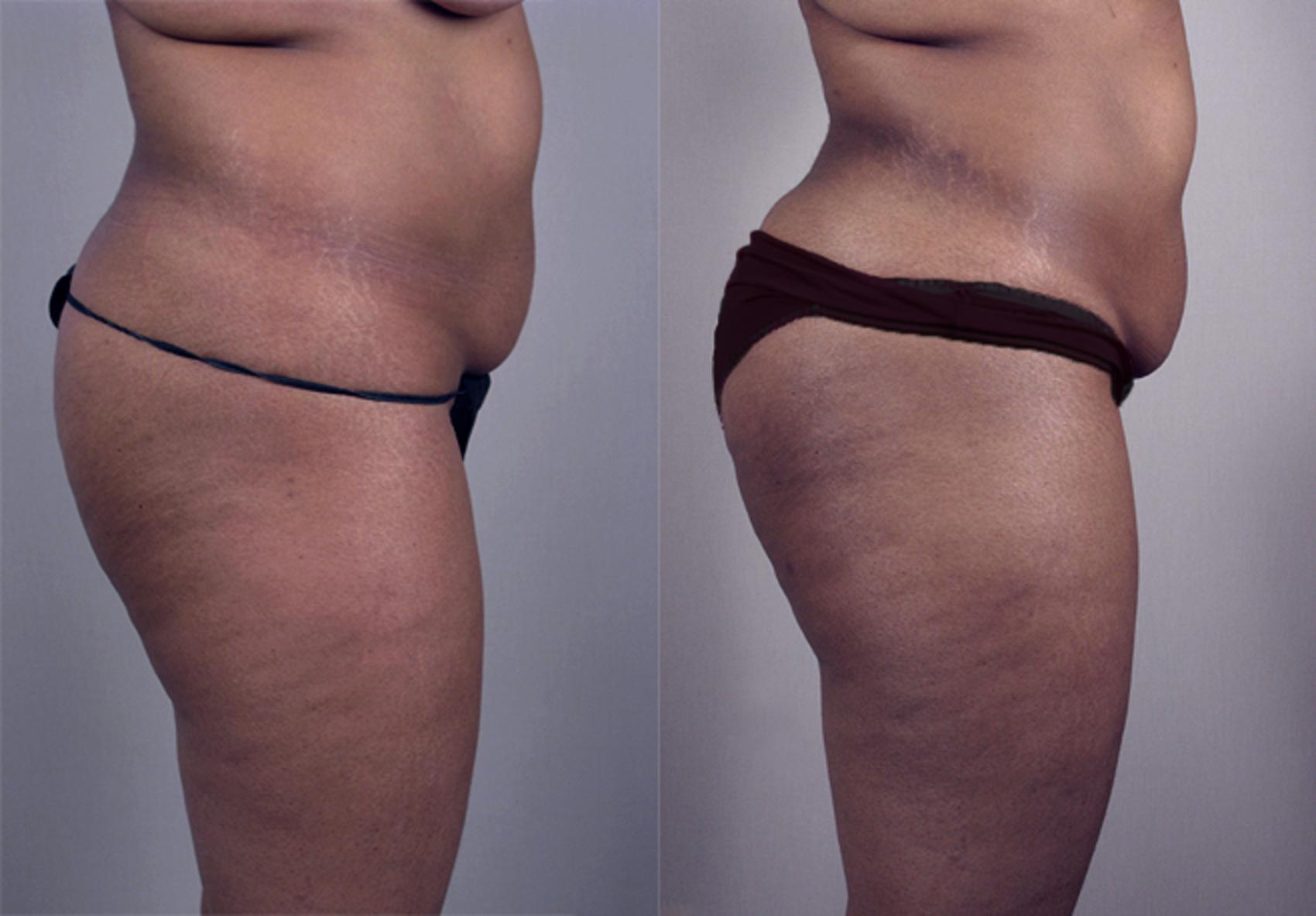 Brazilian Butt Lift Case 775 Before & After View #2 | Paramus, NJ | Parker Center for Plastic Surgery