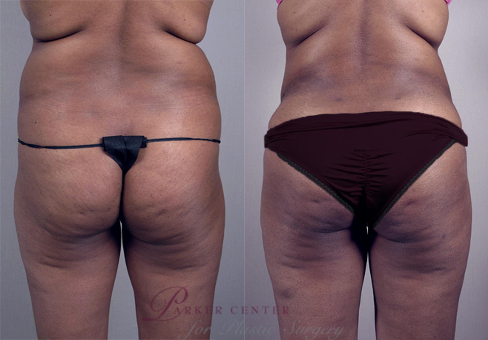 Brazilian Butt Lift Case 775 Before & After View #3 | Paramus, NJ | Parker Center for Plastic Surgery