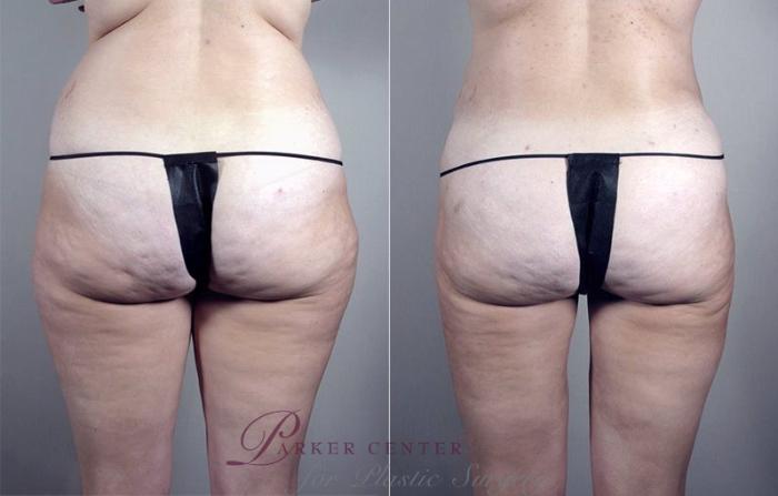 Brazilian Butt Lift Case 791 Before & After View #1 | Paramus, NJ | Parker Center for Plastic Surgery