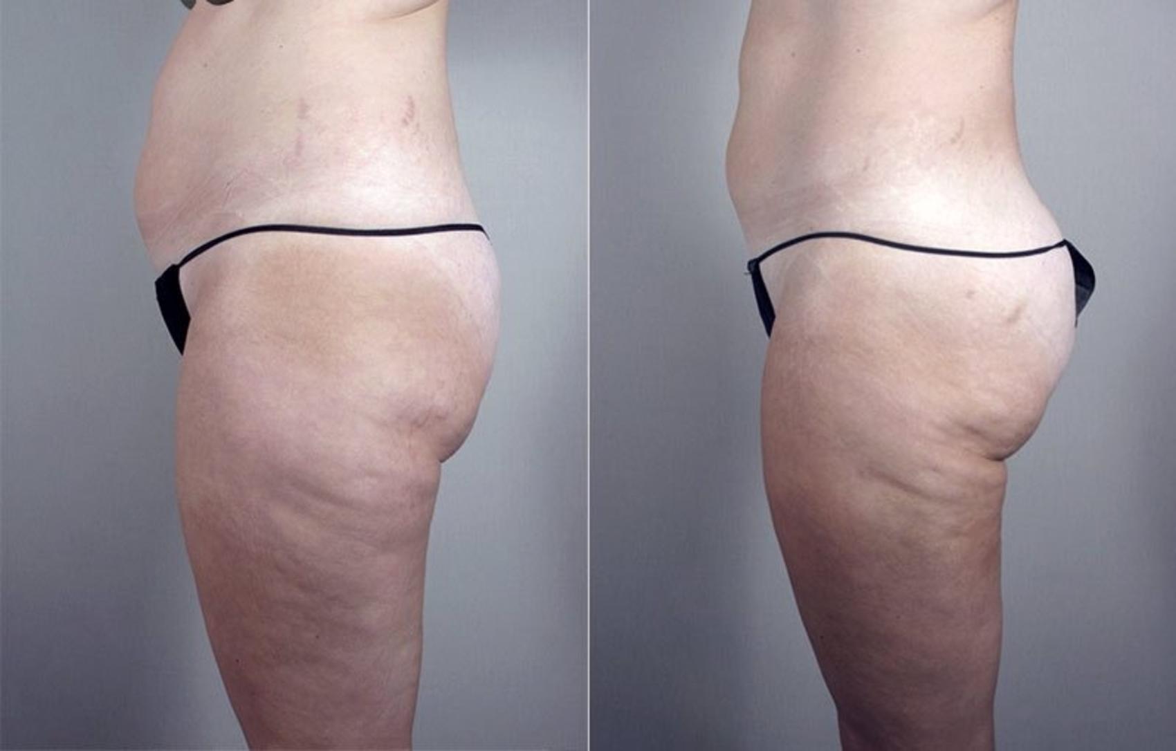 Brazilian Butt Lift Case 791 Before & After View #2 | Paramus, New Jersey | Parker Center for Plastic Surgery