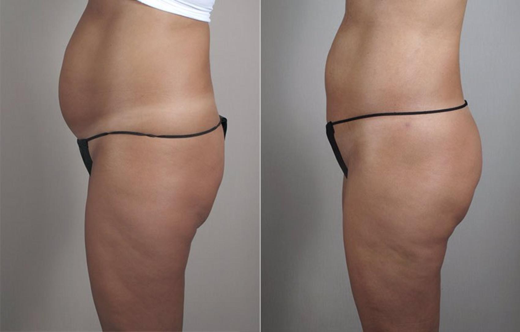 Brazilian Butt Lift with Fat Transfer Northridge, Simi Valley