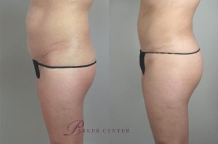 Brazilian Butt Lift Case 937 Before & After View #1 | Paramus, NJ | Parker Center for Plastic Surgery
