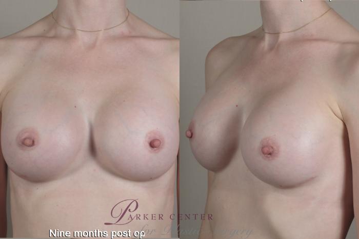 Breast Case 1357 Before & After months  | Paramus, NJ | Parker Center for Plastic Surgery