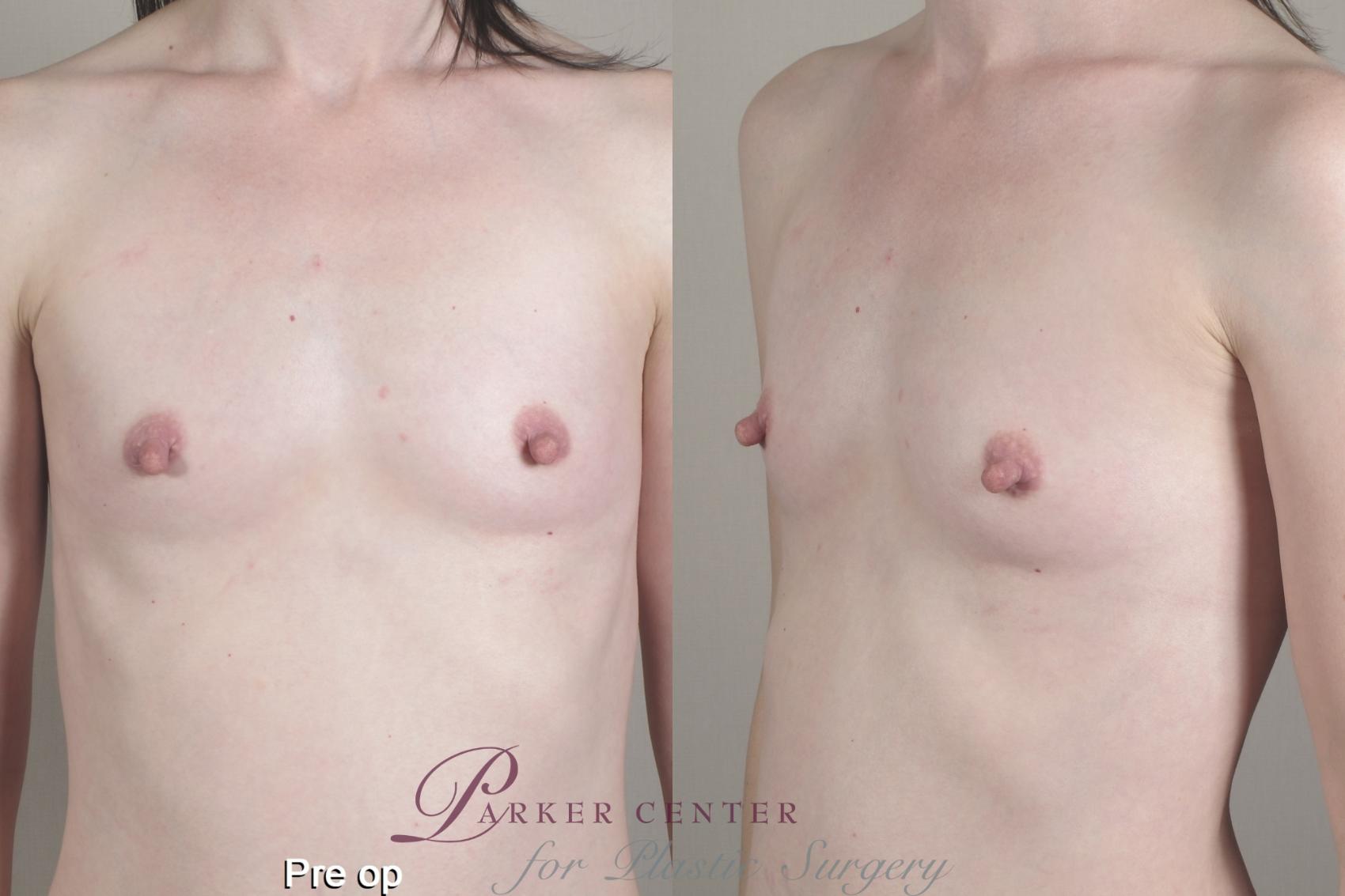 Breast Case 1357 Before & After pre op  | Paramus, NJ | Parker Center for Plastic Surgery