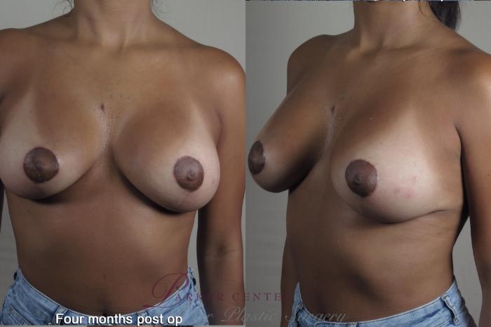 Breast Case 1358 Before & After months  | Paramus, NJ | Parker Center for Plastic Surgery