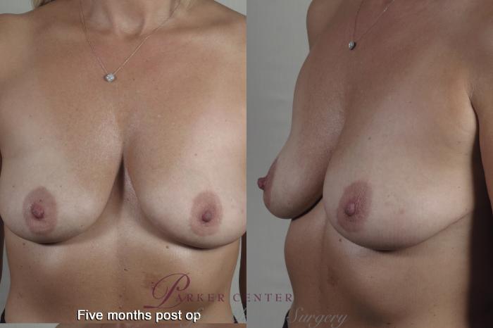 Breast Case 1359 Before & After months  | Paramus, NJ | Parker Center for Plastic Surgery