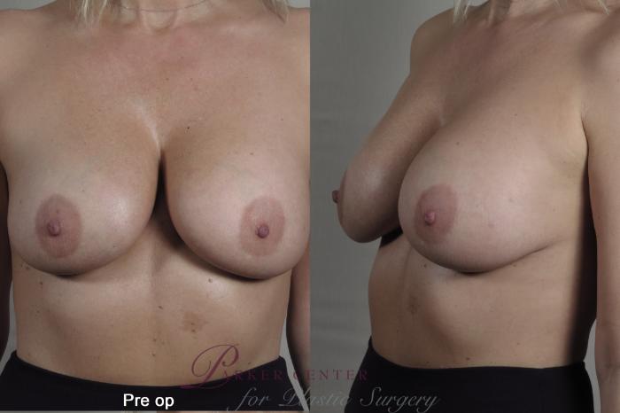 Breast Case 1359 Before & After pre op  | Paramus, NJ | Parker Center for Plastic Surgery