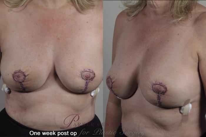 Breast Case 1360 Before & After 1 week  | Paramus, NJ | Parker Center for Plastic Surgery