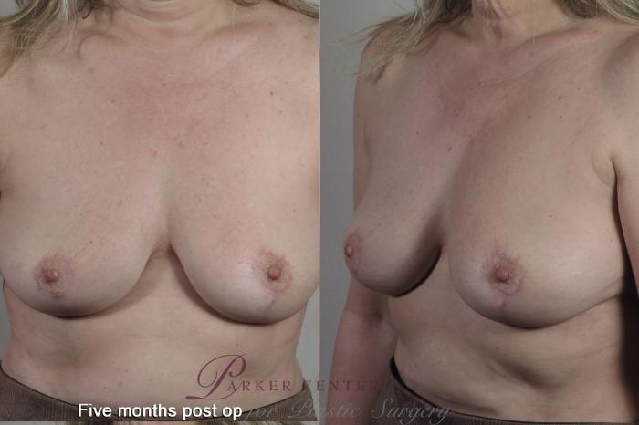 Breast Case 1360 Before & After months  | Paramus, NJ | Parker Center for Plastic Surgery