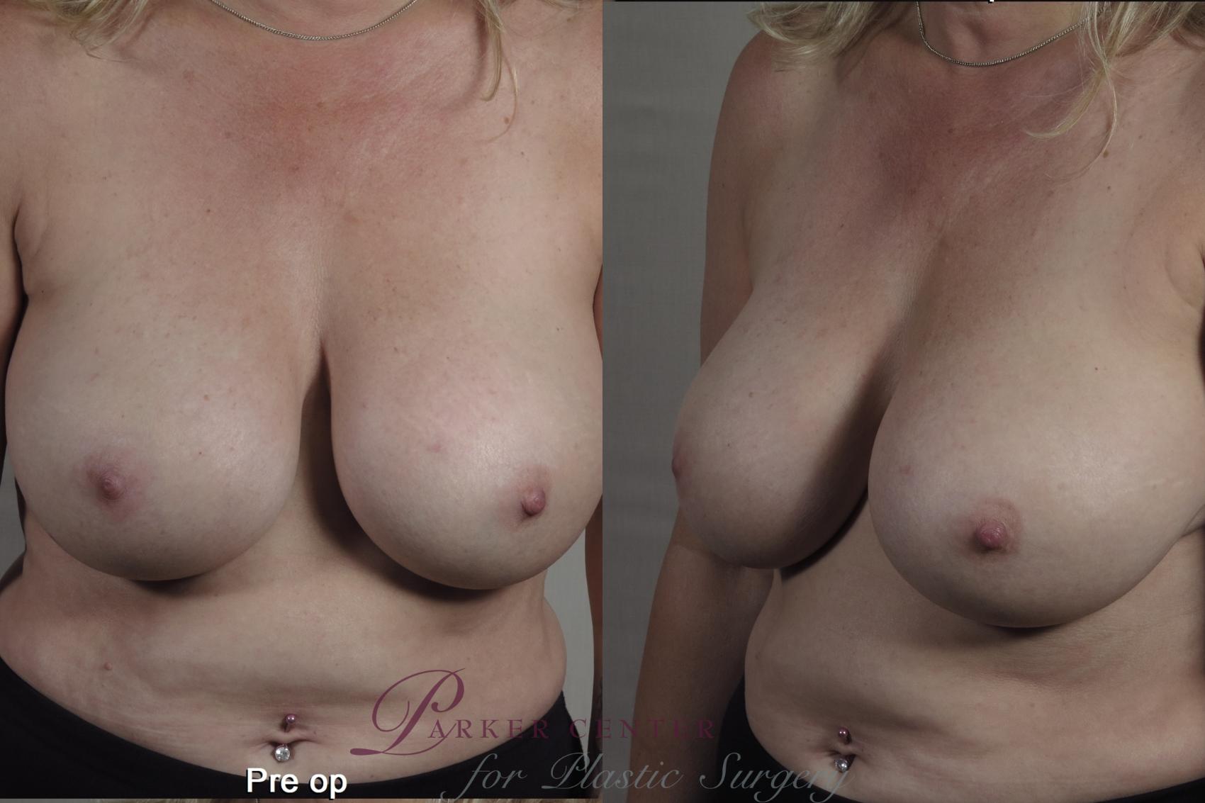 Breast Case 1360 Before & After pre op  | Paramus, NJ | Parker Center for Plastic Surgery