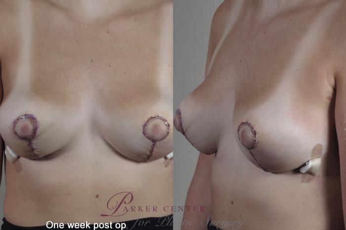 Breast Case 1361 Before & After 1 week  | Paramus, NJ | Parker Center for Plastic Surgery
