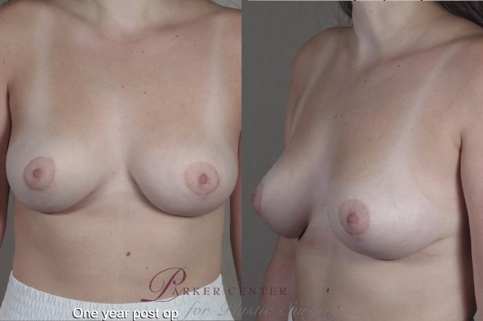 Breast Case 1361 Before & After months  | Paramus, NJ | Parker Center for Plastic Surgery