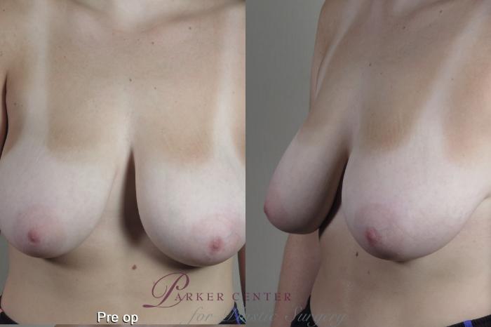 Breast Case 1361 Before & After pre op  | Paramus, NJ | Parker Center for Plastic Surgery