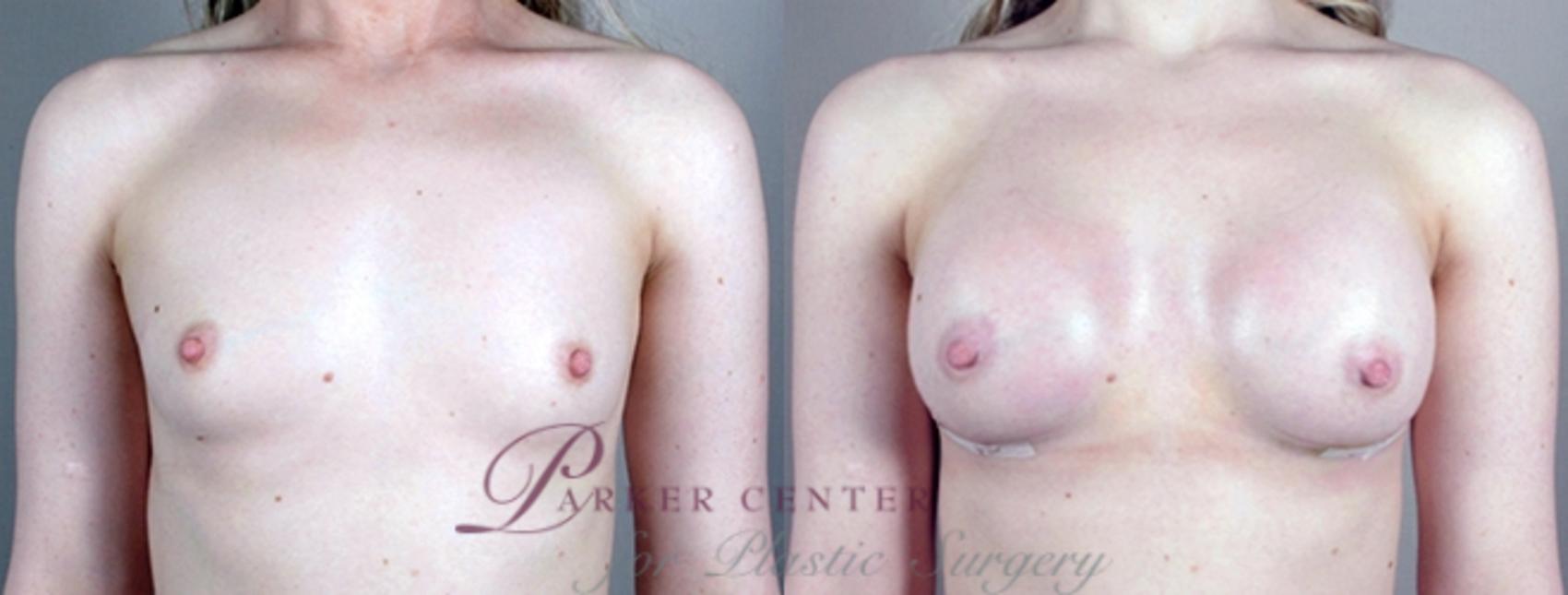 Breast Case 855 Before & After View #1 | Paramus, NJ | Parker Center for Plastic Surgery