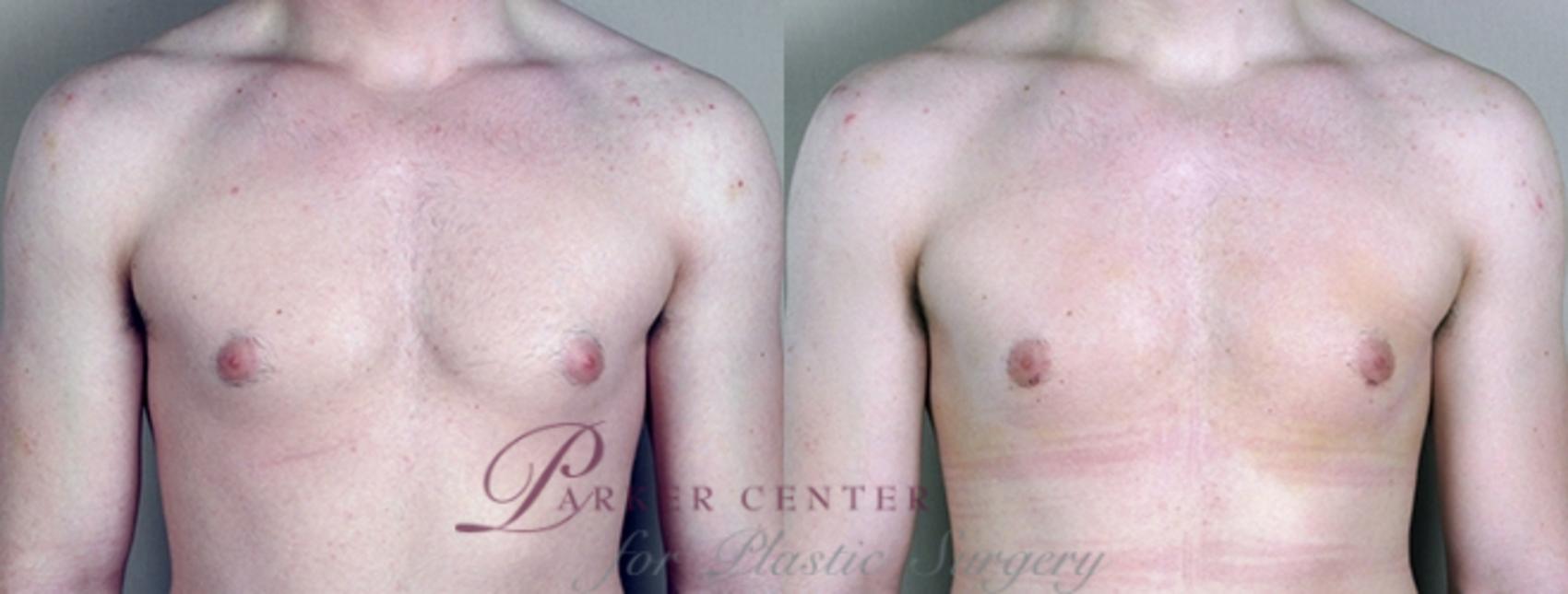 Breast Case 858 Before & After View #1 | Paramus, NJ | Parker Center for Plastic Surgery