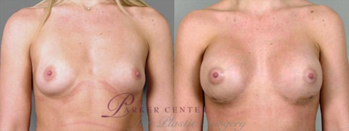 Breast Case 859 Before & After View #1 | Paramus, NJ | Parker Center for Plastic Surgery