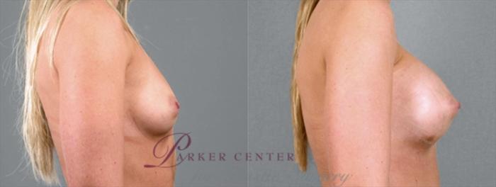 Breast Case 859 Before & After View #2 | Paramus, NJ | Parker Center for Plastic Surgery