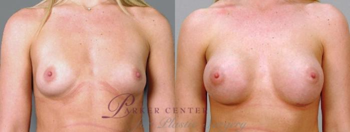 Breast Case 859 Before & After View #3 | Paramus, NJ | Parker Center for Plastic Surgery