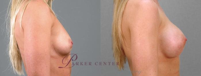 Breast Case 859 Before & After View #4 | Paramus, NJ | Parker Center for Plastic Surgery