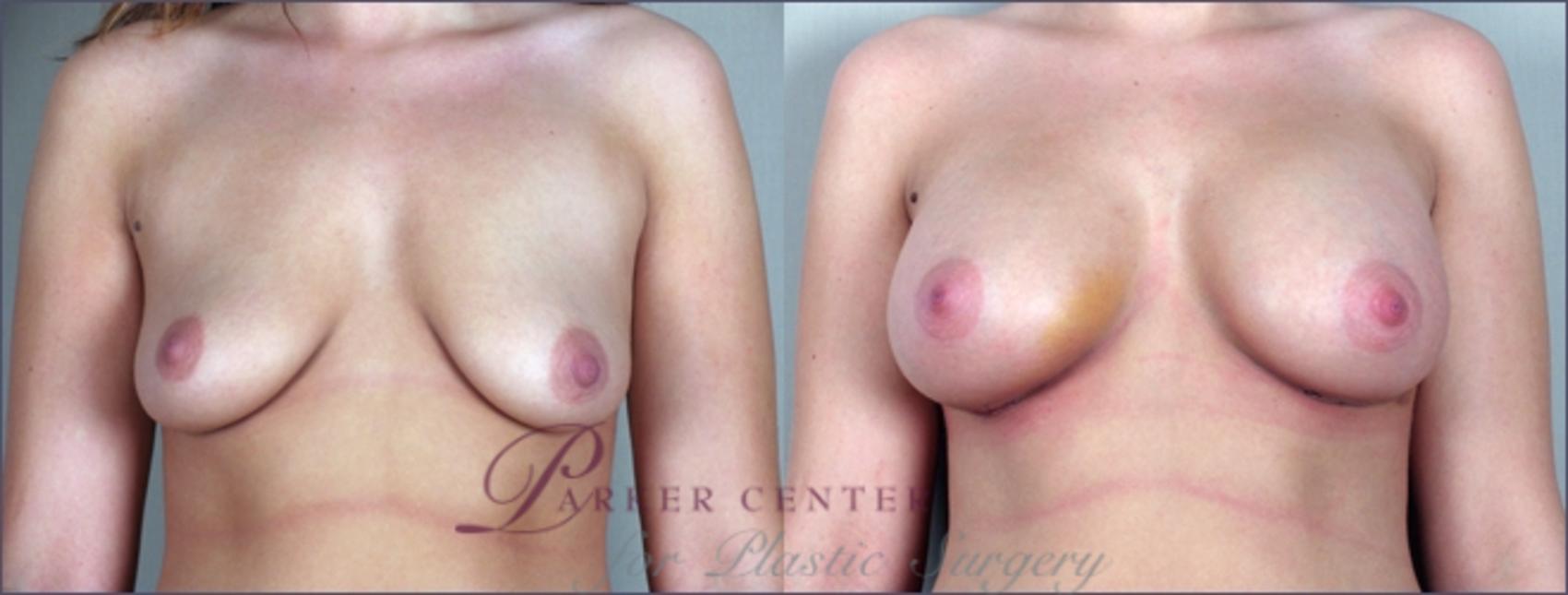 Breast Case 860 Before & After View #1 | Paramus, NJ | Parker Center for Plastic Surgery