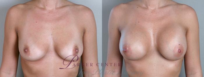 Breast Case 861 Before & After View #1 | Paramus, NJ | Parker Center for Plastic Surgery