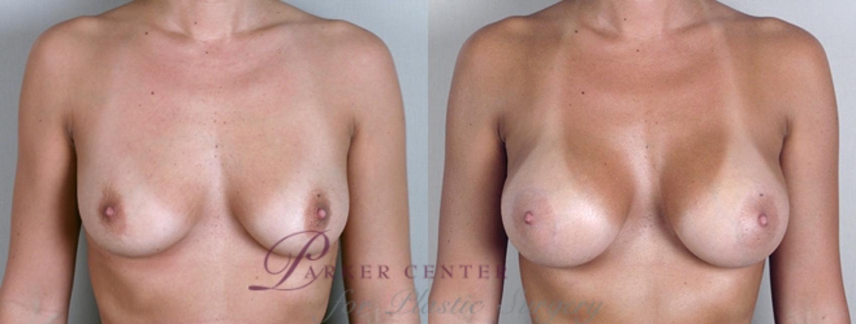 Breast Case 861 Before & After View #2 | Paramus, NJ | Parker Center for Plastic Surgery