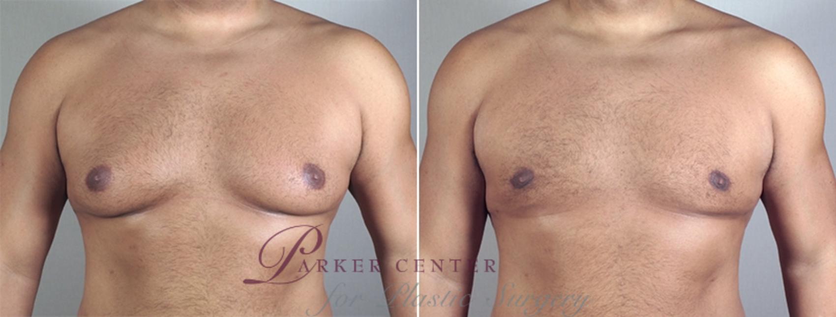 Breast Case 862 Before & After View #2 | Paramus, NJ | Parker Center for Plastic Surgery