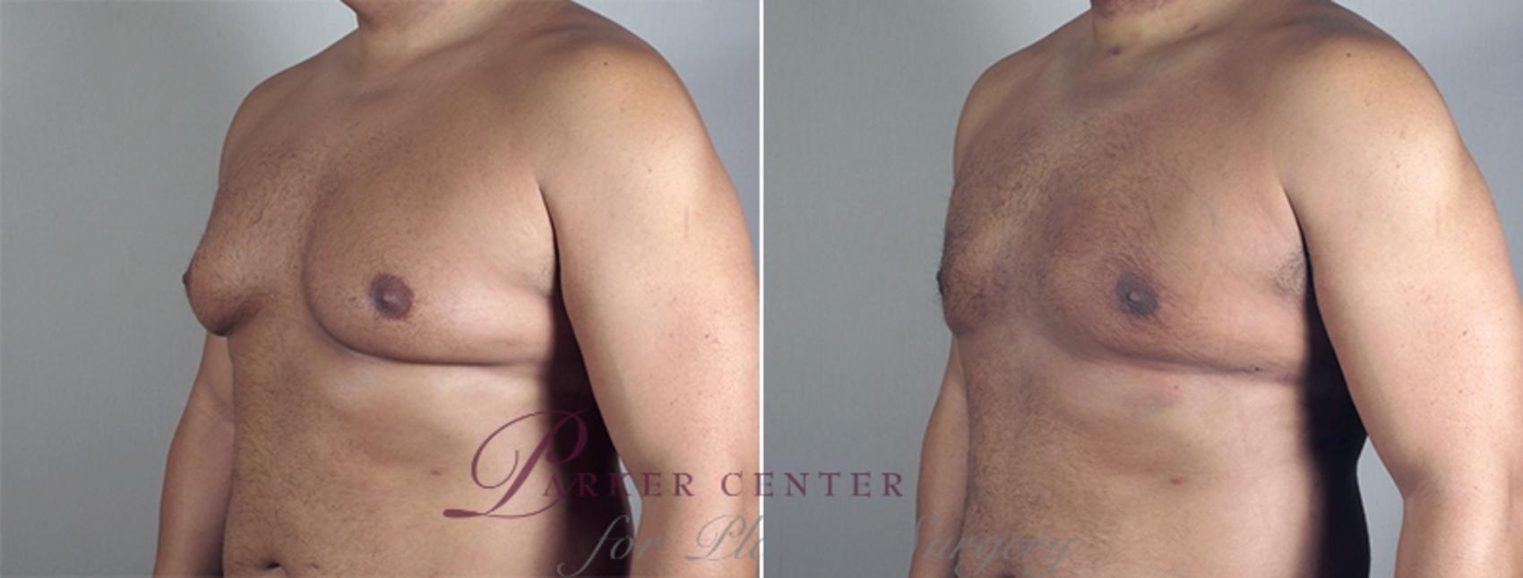 Breast Case 862 Before & After View #3 | Paramus, NJ | Parker Center for Plastic Surgery