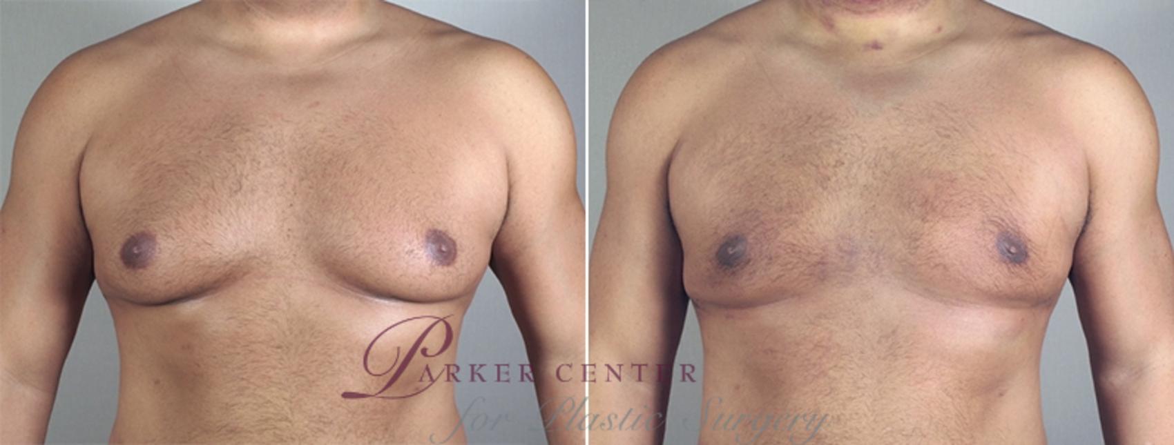 Breast Case 862 Before & After View #4 | Paramus, NJ | Parker Center for Plastic Surgery