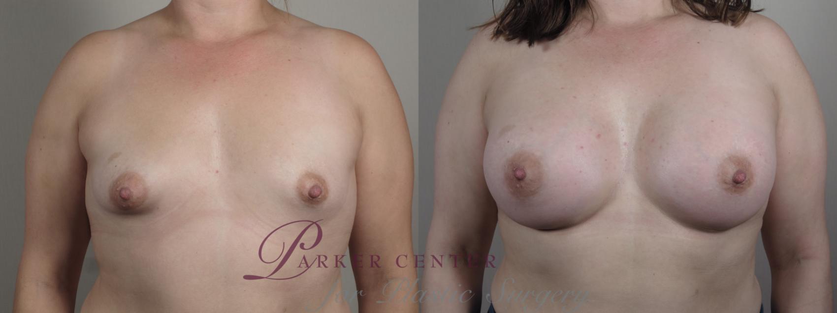 Breast Augmentation Case 1008 Before & After Front | Paramus, NJ | Parker Center for Plastic Surgery