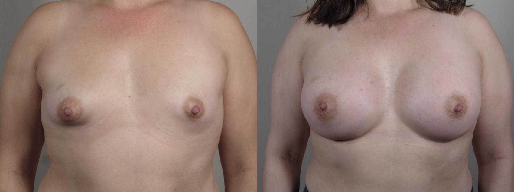 Breast Asymmetry Case 1008 Before & After Front | Paramus, New Jersey | Parker Center for Plastic Surgery