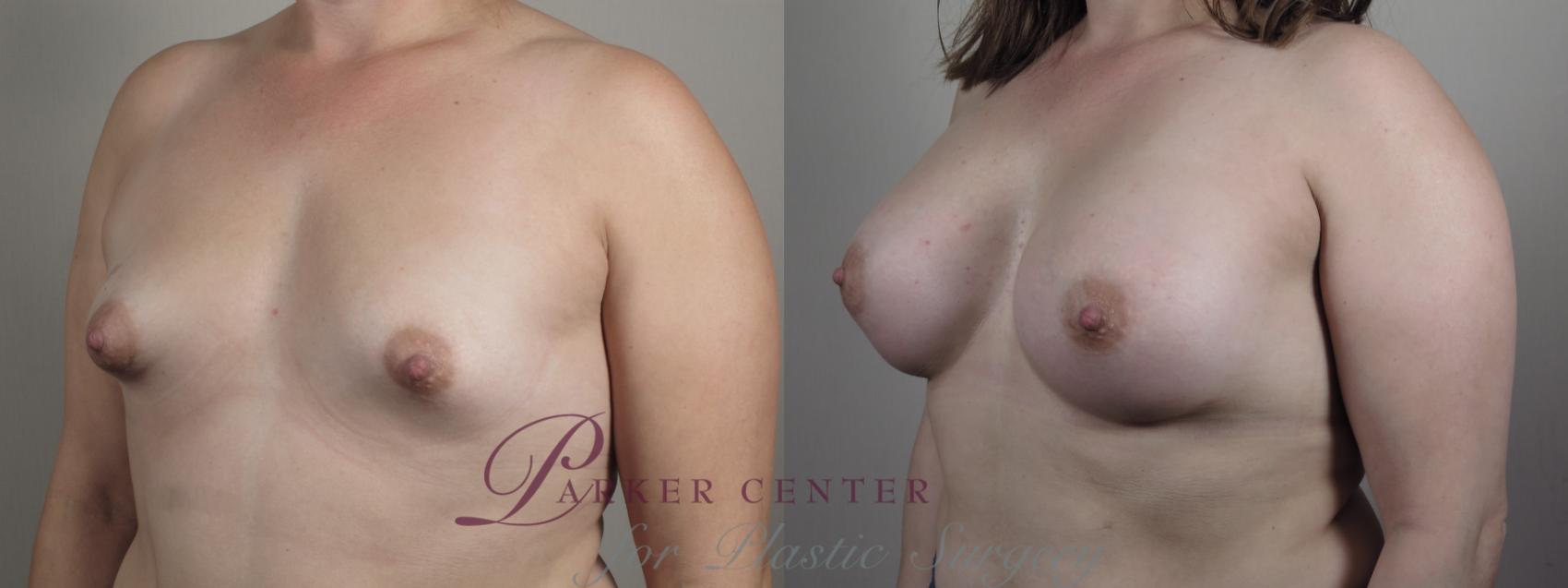 Breast Augmentation Case 1008 Before & After Right Oblique | Paramus, NJ | Parker Center for Plastic Surgery