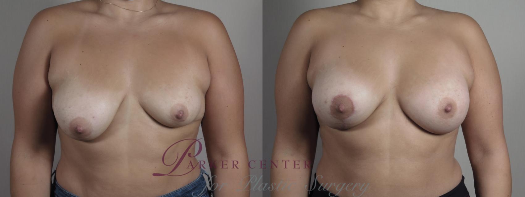 Breast Asymmetry Case 1012 Before & After Front | Paramus, NJ | Parker Center for Plastic Surgery